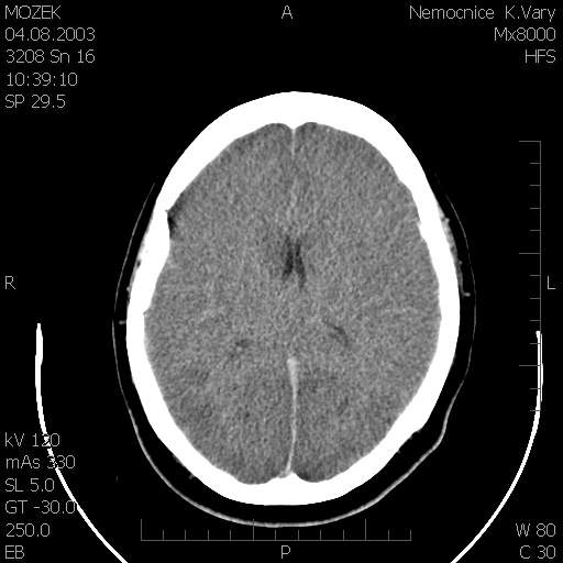 Obr. . 1: CT mozku