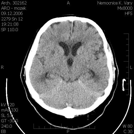 Obr. . 6: CT mozku