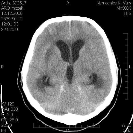 Obr. . 7: CT mozku
