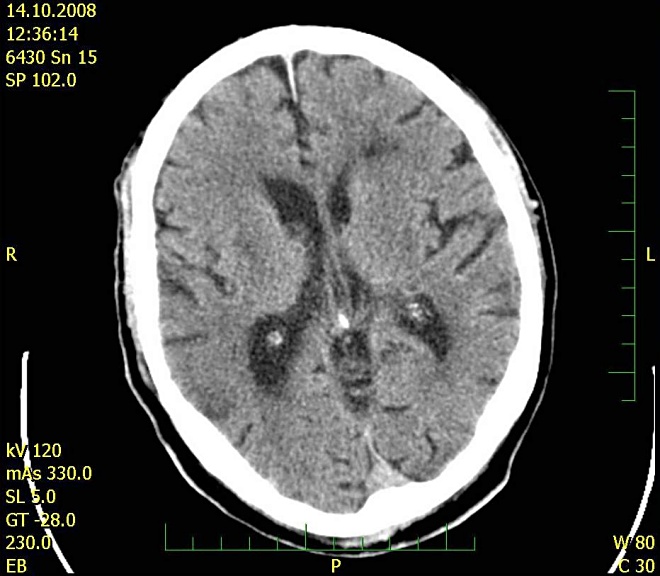 Obr. . 1: CT mozku 14.10.2008