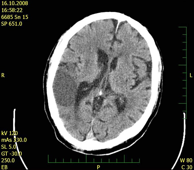 Obr. . 5: CT mozku 16.10.2008