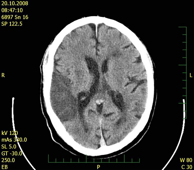 Obr. . 6: CT mozku 20.10.2008