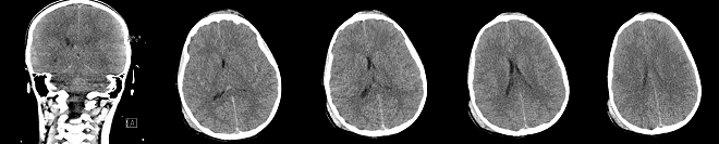 Obr.č.1: CT mozku - vybrané řezy v koronární a transverzální rovině, maligní traumatický edém mozku, edém v zadní jámě lební,<br> drobné subarachnoideální krvácení fronto-parietálně bilat., v oblasti Sylviových rýh, zakrvácení podél tentoria.