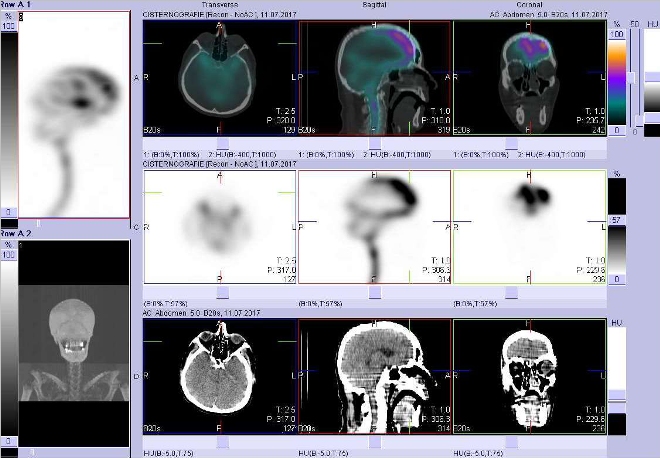 Obr.č.3: Fúze obrazů SPECT a CT – vyšetření lebky a mozku 24 hod. po aplikaci radiofarmaka. Vpravo nahoře fúze SPECT a CT, vpravo uprostřed SPECT, vpravo dole CT. Zaměřeno na kořen nosu.