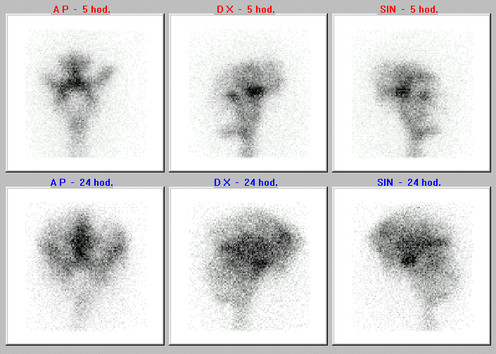 Obr. . 1: Radionuklidov cisternografie  nahoe scintigramy za 5 hod., dole za 24 hod., vdy v pedn, prav a lev bon projekci