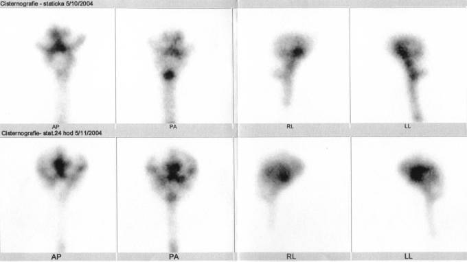 Obr. . 2: Radionuklidov cisternografie  nahoe scintigramy za 5hod., dole za 24hod., vdy v pedn, zadn, prav a lev bon projekci