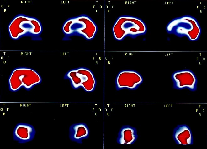 Obr. . 2: SPECT mozku na jednohlav tomografick kamee-sagitln ezy