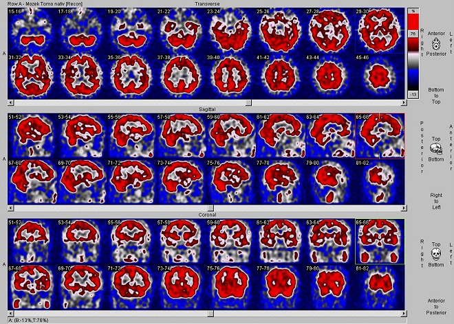 Obr. . 1: SPECT mozku na dvouhlav tomografick kamee