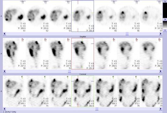 Obr. č. 4: Tomografická scintigrafie břicha a pánve 24,5 hod. po aplikaci OctreoScanu