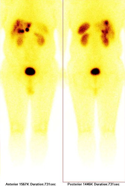 Obr. č.1: Celotělová scintigrafie 111In-pentetreotide (OctreoScan) v přední a zadní projekci