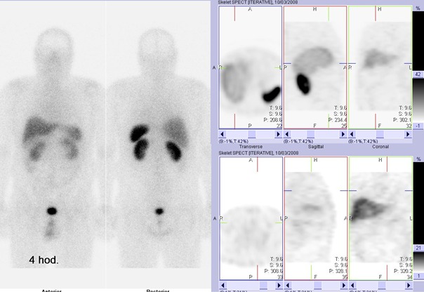Obr. č. 1: Celotělová scintigrafie v přední a zadní projekci a cílená tomografická scintigrafie hrudníku a břicha 4 hod. po aplikaci OctreoScanu