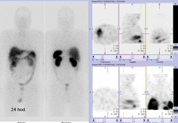 Obr. č. 2: Celotělová scintigrafie v přední a zadní projekci a cílená tomografická scintigrafie hrudníku 24 hod. po aplikaci OctreoScanu