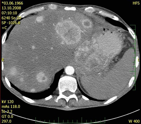 Obr. č. 3 : CT břicha – mnohočetné metastázy jater