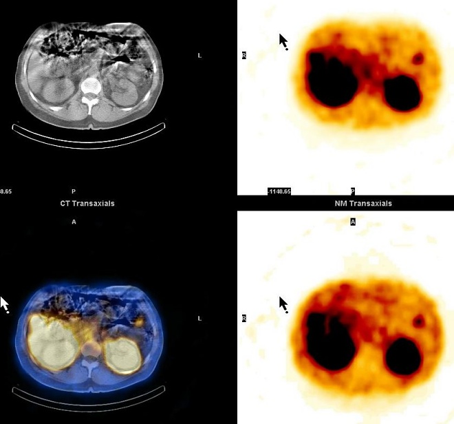 Obr. 13. SPECT, CT, SPECT/CT dutiny břišní, transverzální řez, metastáza v epigastriu vlevo