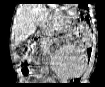 Obr. 4. CT dutiny břišní, koronární řez