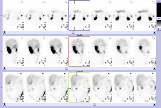 Obr. 4: Tomografická scintigrafie břicha a pánve 24 hod. po aplikaci OctreoScanu