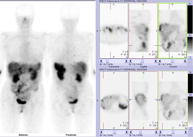 Obr. 2: Celotělová scintigrafie (vlevo) a SPECT břicha a dolní části hrudníku 4 hod. po aplikaci OctreoScanu