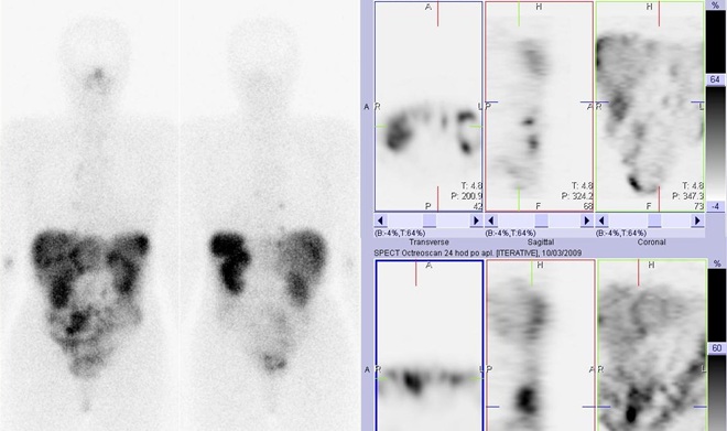 Obr. 4: Celotělová scintigrafie (vlevo) a SPECT břicha 24 hod. po aplikaci OctreoScanu.