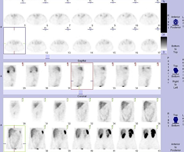 Obr. č. 2:  Tomografická scintigrafie břicha a pánve 5 hod. po aplikaci OctreoScanu