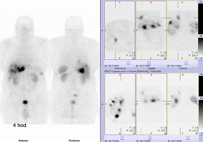 Obr.č.1: Celotělová scintigrafie v přední a zadní projekci a tomografická (SPECT) scintigrafie břicha 4 hod. po aplikaci OctreoScanu