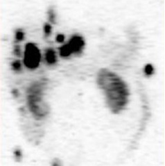 Obr.č.4: Tomografická (SPECT) scintigrafie břicha 24 hod. po aplikaci OctreoScanu – 3 D