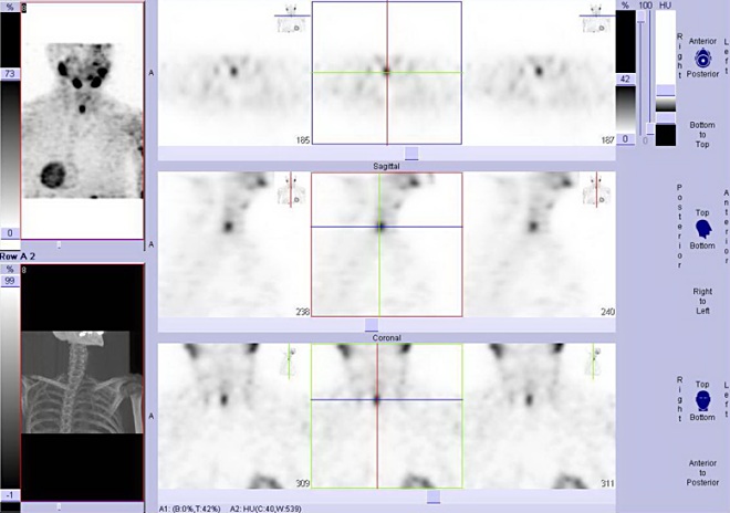 Obr. č. 3: Tomografická scintigrafie krku 3 hodiny po aplikaci radioindikátoru