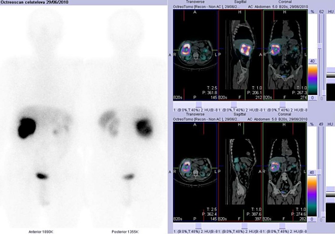 Obr. č. 3: Celotělová scintigrafie v přední a zadní projekci a fúze obrazů SPECT a CT