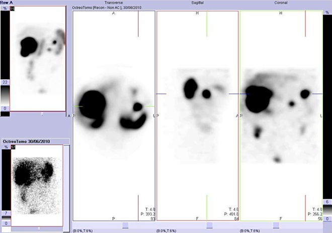 Obr. č. 6: Tomografická scintigrafie břicha a pánve 24 hod. po aplikaci OctreoScanu