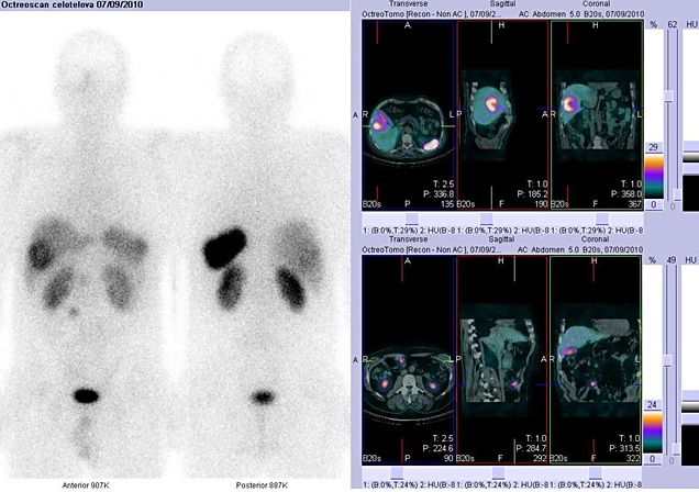 Obr. č. 3: Celotělová scintigrafie v přední a zadní projekci a fúze obrazů SPECT a CT