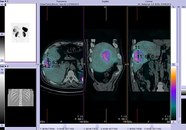 Obr. č. 4: Fúze obrazů SPECT a CT. Vyšetření 4 hod. po aplikaci radioindikátoru