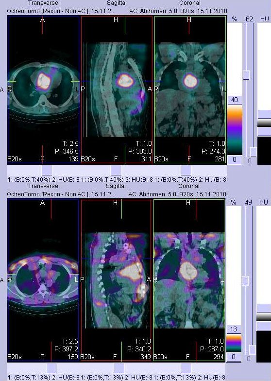 Obr. č. 3: Fúze obrazů SPECT a CT - hrudník. Vyšetření 4 hod. po aplikaci radioindikátoru. Vlevo transverzální  řezy, uprostřed sagitální řezy, vpravo řezy koronární. Zaměřeno na dvě ložiska v plicích.