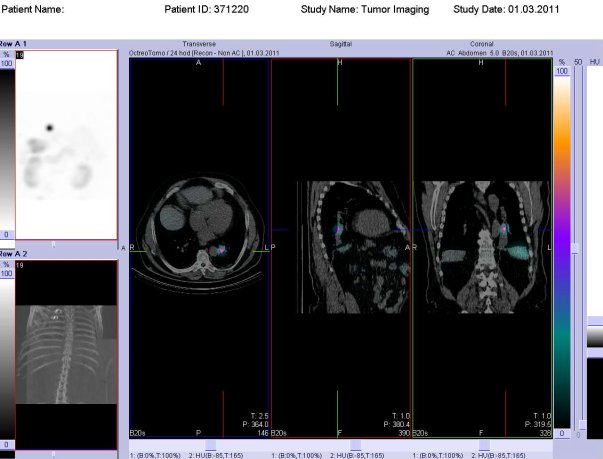 Obr. č. 5: Fúze obrazů SPECT a CT. Vyšetření 24 hod. po aplikaci radioindikátoru. Vlevo transverzální řez, uprostřed sagitální řez, vpravo řez koronární. Zaměřeno na ložisko v levé plíci.