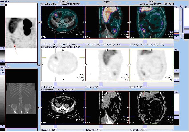 Obr. č. 2: Fúze obrazů SPECT a CT. Vyšetření 5 hod. po aplikaci radioindikátoru. Zaměřeno na ložisko v pravém hypogastriu.