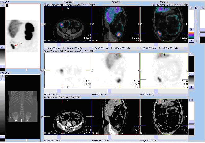 Obr.č.4: Fúze obrazů SPECT a CT. Vyšetření 24 hod. po aplikaci radioindikátoru. Zaměřeno na ložisko v pravém hypogastriu.
