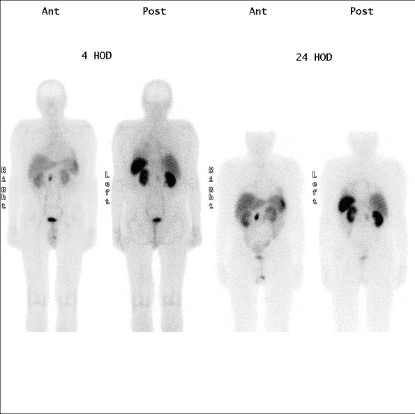 Obr.1: Scintigrafie pomocí 111In-OctreoScan metodou „whole body“ za 4 a 24 hodin po aplikaci radiofarmaka s  patologickou ložiskovou depozicí radiofarmaka v oblasti epigastria.