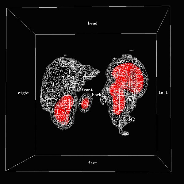 Obr.3: Scintigrafie pomocí 111In-OctreoScan metodou SPECT v 3D zobrazení s patologickou depozicí radiofarmaka v oblasti epigastria.