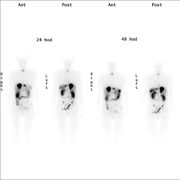 Obr.1: Scintigrafie pomocí 111In-OctreoScan metodou „whole body“ za 24 a 48 hodin po aplikaci radiofarmaka s  patologickými ložiskovými depozicemi radiofarmaka v oblasti jater a skeletu.