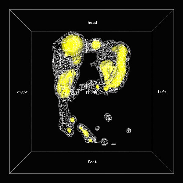 Obr.3: Scintigrafie pomocí 111In-OctreoScan metodou SPECT v 3D zobrazení s  patologickými ložiskovými depozicemi radiofarmaka v oblasti jater a skeletu.