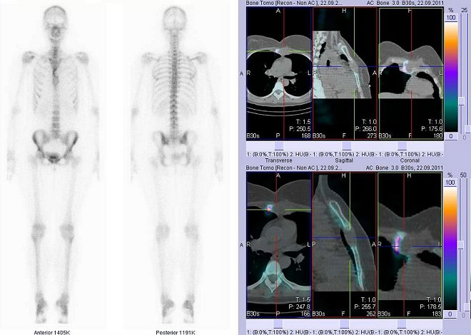 Obr. č. 2: Celotělová scintigrafie v přední a zadní projekci a fúze obrazů SPECT a CT.  Vpravo zaměřeno na velké osteolytické zeložisko ve sternu. Řezy transverzální, řezy sagitální a řezy koronální.