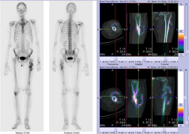 Obr. č.3: Celotělová scintigrafie v přední a zadní projekci a fúze obrazů SPECT a CT.  Vpravo zaměřeno na ložisko v horní části levého stehna. Řezy transverzální, řezy sagitální a řezy koronální.