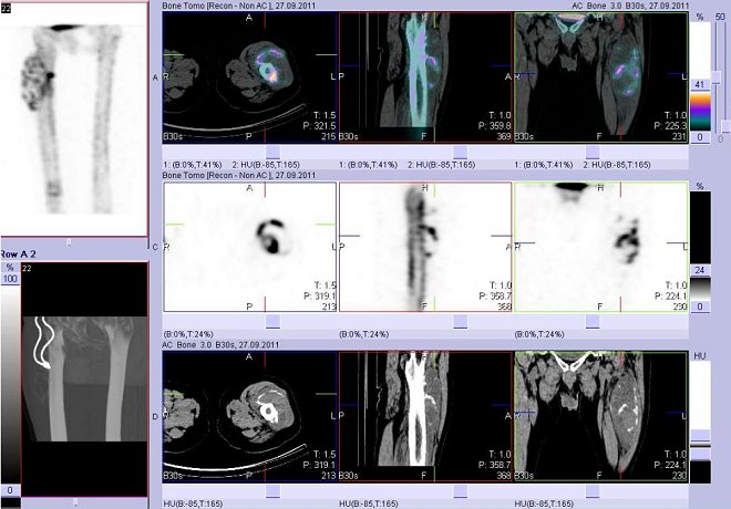 Obr. č. 4: Fúze obrazů SPECT a CT. Zaměřeno na velké ložisko v horní části levého stehna. Řezy transverzální, řezy sagitální a řezy koronální.