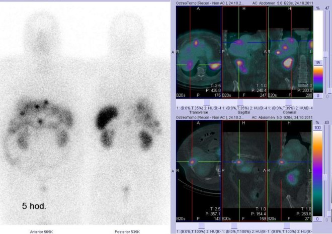 Obr. č. 4: Celotělová scintigrafie v přední a zadní projekci a fúze obrazů SPECT a CT. Vyšetření 5 hod. po aplikaci radioindikátoru. Vpravo nahoře: zaměřeno na ložisko v pravém jaterním laloku. Vpravo dole: zaměřeno na další ložisko v pravém jaterním laloku.