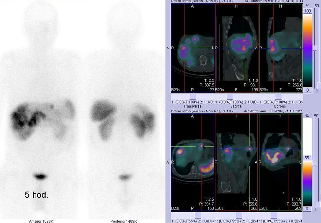 Obr. č. 4: Celotělová scintigrafie v přední a zadní projekci a fúze obrazů SPECT a CT. Vyšetření 5 hod. po aplikaci radioindikátoru. Vpravo nahoře: zaměřeno na ložisko v pravém jaterním laloku. Vpravo dole: zaměřeno na ložisko v levém jaterním laloku.
