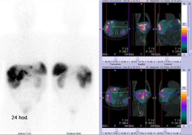 Obr. č. 7: Celotělová scintigrafie v přední a zadní projekci a fúze obrazů SPECT a CT. Vyšetření 24 hod. po aplikaci radioindikátoru. Vpravo: zaměřeno na ložisko v pravém jaterním laloku.