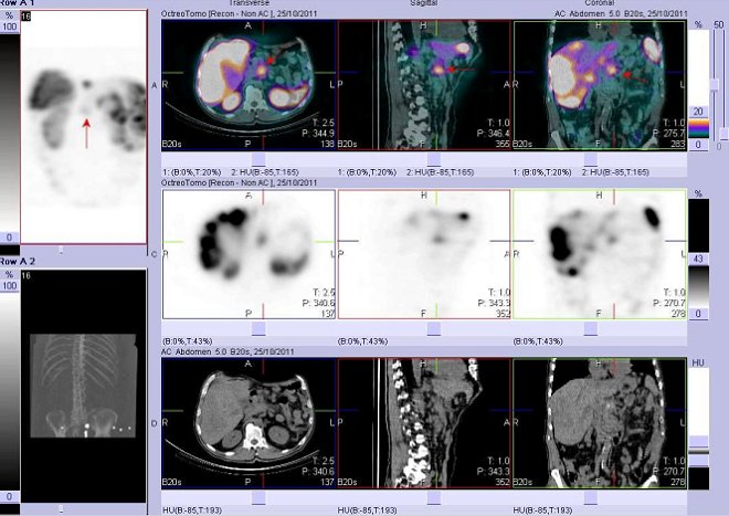 Obr. č. 9: Fúze obrazů SPECT a CT. Vyšetření 24 hod. po aplikaci radioindikátoru. Zaměřeno na ložisko ve střední čáře, zřejmě v pankreatu.
