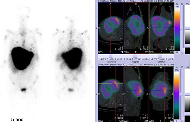 Obr. č. 2: Celotělová scintigrafie v přední a zadní projekci a fúze obrazů SPECT a CT. Vyšetření 5 hod. po aplikaci radioindikátoru. Vpravo: zaměřeno na obrovské ložisko v játrech.