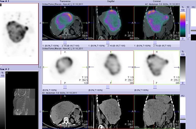 Obr. č. 3: Fúze obrazů SPECT a CT. Vyšetření 5 hod. po aplikaci radiofarmaka. Zaměřeno na ložisko v játrech.
