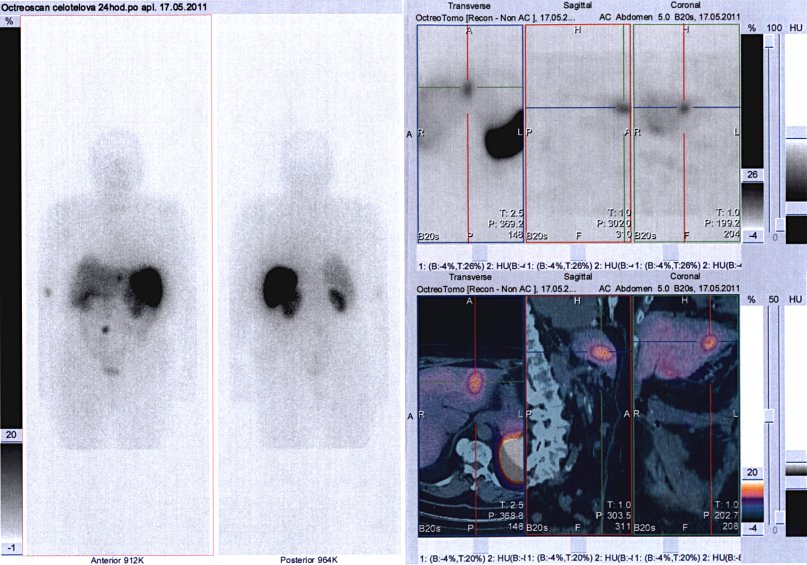 Obr. č. 4: Celotělová scintigrafie v přední a zadní projekci a fúze obrazů SPECT a CT. Vyšetření 24 hod. po aplikaci radioindikátoru. Zaměřeno na ložisko v levém jaterním laloku.