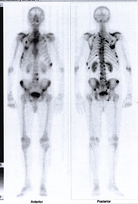 Obr. č. 1: Celotělová scintigrafie  skeletu v přední a zadní projekci.