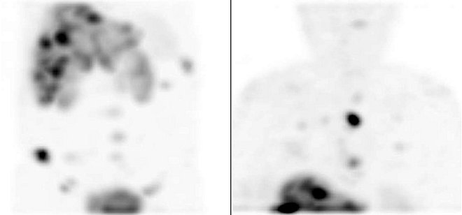 Obr. č. 3: Tomografická scintigrafie SPECT. Vyšetření 4 hod. po aplikaci radioindikátoru. Vlevo SPECT břicha a pánve, vpravo SPECT hrudníku.